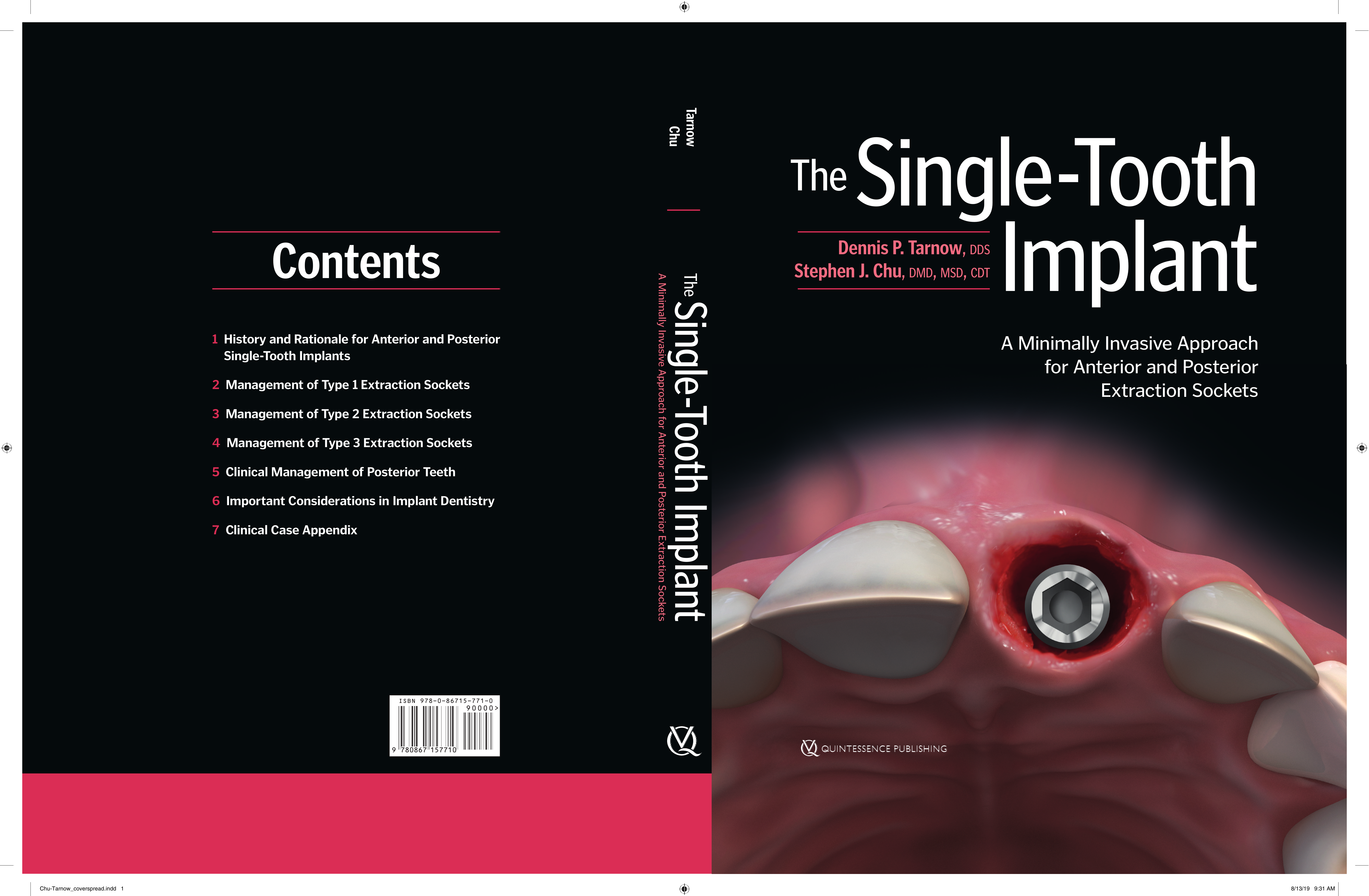 The Single-tooth Implant